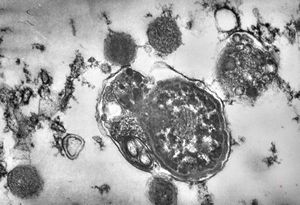 F,49y. | phagocytosed microbes - purulent meningitis